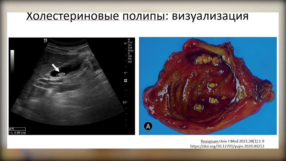 Песок в почках – симптомы, причины, диагностика и лечение у женщин и мужчин в «СМ-Клиника»